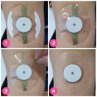 Overpatches Fixierpflaster XL - Transparent - 20 Stück